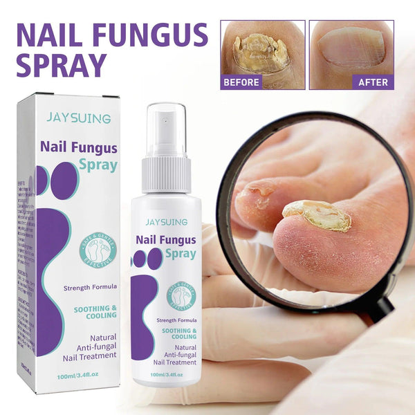 Spray de reparo de onicomicose Tratamento de fungos nas unhas Mão Pé Unhas macias Espessamento de unhas Limpeza de cuidados Hongos Uñas Pies